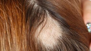 Alopecija areata