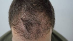 Alopecija kod muškaraca