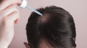 Minoxidil - Revolucionarni Tretman Za Gubitak Kose
